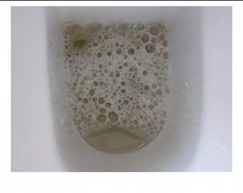 "You Might Have A Serious Medical Illness If Your Urine Looks Like This"- Nigerian Doctor Warns
