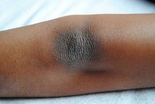 10 Natural Ways To Remove Dark Knees and Elbows
