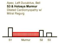 Heart Sounds 12 Apex, Left Lateral decubitus, Bell S3 & Holosystolic Murmur, Dilated cardiomyopathy with Mitral regurgitation.mp3