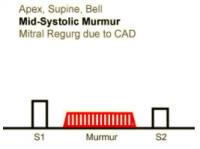 Heart sounds 07 Apex, Mid Systolic Murmur, Mitral regurgitation due to Coronary Artery disease, Supine, Bell.mp3