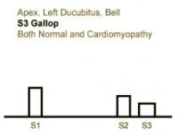 Heart sounds 05 Apex, S3 Gallop, Left Lateral Decubitus, Normal and Cardiomyopathy.mp3