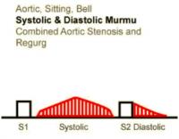 Heart Sounds 17 Aortic, Sitting, Bell Systolic and Diastolic Murmur, Combined Aortic Stenosis and regurgitation.mp3