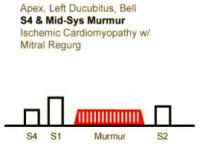 Heart Sounds 11 Apex, Left lateral decubitus, Bell S4 and Mid Systolic Murmur, Ischemic cardiomyopathy with mitral regurgitation.mp3