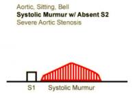 Heart Sounds 15 Aortic, Sitting, Bell, Systolic Murmur with Absent S2, Severe Aortic Stenosis.mp3