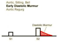 Heart Sounds 16 Aortic, Sitting, Bell, Early Diastolic Murmur, Aortic regurgitation.mp3